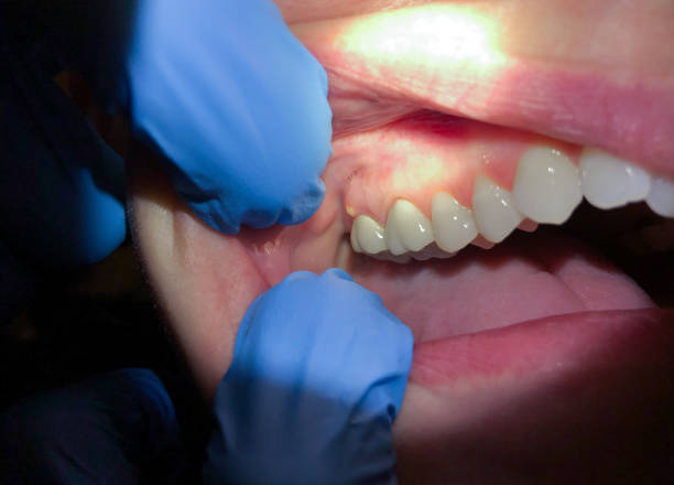 Best Emergency Dental Care for Broken or Chipped Teeth in Brooklyn, OH