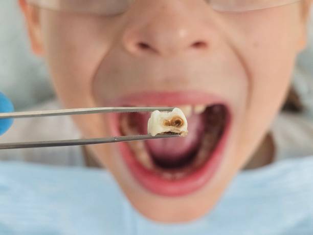 Best Emergency Treatment for Dental Infections or Abscesses in Brooklyn, OH